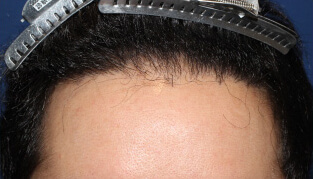 20代 男性 N.R.さん 生え際の自毛植毛（NC-MIRAI法） 1,300株の症例（施術後）