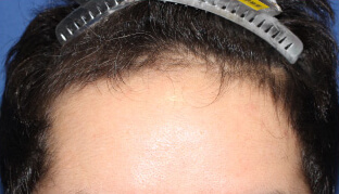 20代 男性 N.R.さん 生え際の自毛植毛（NC-MIRAI法） 1,300株の症例（施術前）
