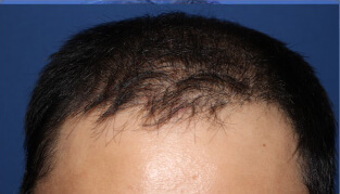 30代 男性 N.T.さん 生え際・前頭部の自毛植毛（MIRAI法） 2,000株の症例（施術後）
