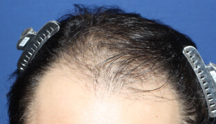 30代 男性 N.T.さん 生え際・前頭部の自毛植毛（MIRAI法） 2,000株の症例（施術前）