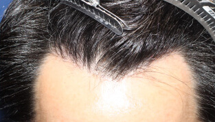 0代 男性 O.M.さん 生え際の自毛植毛（NC-MIRAI法） 900株の症例（施術後）