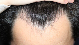 0代 男性 O.M.さん 生え際の自毛植毛（NC-MIRAI法） 900株の症例（施術前）
