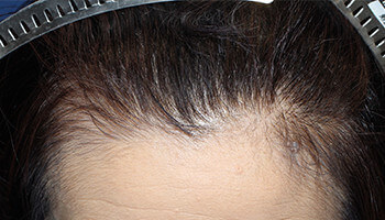 50代 女性 O.R.さん 生え際の自毛植毛（NC-MIRAI法） 1,000株の症例（施術後）