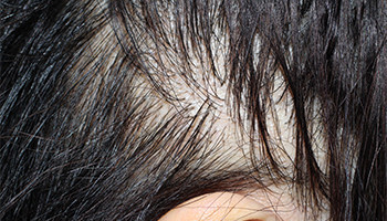 50代 女性 O.R.さん 生え際の自毛植毛（NC-MIRAI法） 1,000株の症例（施術後）