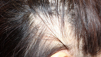 50代 女性 O.R.さん 生え際の自毛植毛（NC-MIRAI法） 1,000株の症例（施術前）