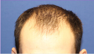 20代 男性 R.S.さん 前頭部・頭頂部の自毛植毛（MIRAI法） 1,400株の症例（施術前）