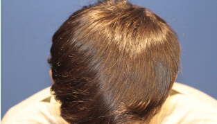 20代 男性 R.S.さん 前頭部・頭頂部の自毛植毛（MIRAI法） 1,400株の症例（施術後）