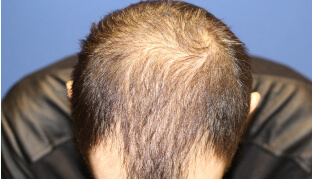 20代 男性 R.S.さん 前頭部・頭頂部の自毛植毛（MIRAI法） 1,400株の症例（施術前）