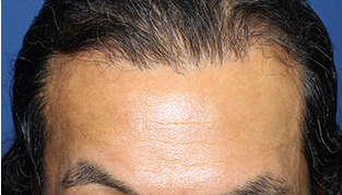 50代 男性 S.A.さん 生え際の自毛植毛（NC-MIRAI法） 2,000株の症例（施術後）