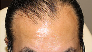 50代 男性 S.A.さん 生え際の自毛植毛（NC-MIRAI法） 2,000株の症例（施術前）