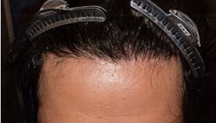 30代 男性 S.D.さん 生え際・頭頂部の自毛植毛（MIRAI法） 1,700株の症例（施術後）