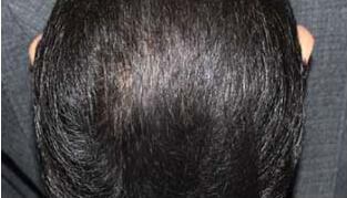 50代 男性 S.H.さん 頭頂部の自毛植毛（MIRAI法） 1,000株の症例（施術後）