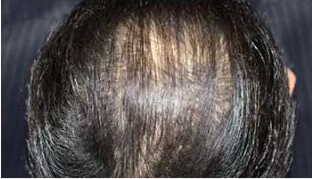 50代 男性 S.H.さん 頭頂部の自毛植毛（MIRAI法） 1,000株の症例（施術前）