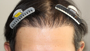 40代 男性 S.H.さん 生え際の自毛植毛（NC-MIRAI法） 900株の症例（施術後）