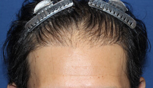 40代 男性 S.H.さん 生え際の自毛植毛（NC-MIRAI法） 900株の症例（施術前）