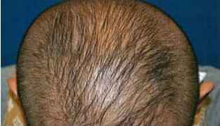50代 男性 S.H.さん 頭部全体の自毛植毛（MIRAI法） 1,230株の症例（施術後）