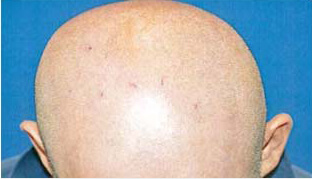 50代 男性 S.H.さん 頭部全体の自毛植毛（MIRAI法） 1,230株の症例（施術前）