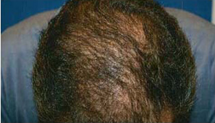 40代 男性 S.J.さん 前頭部・頭頂部の自毛植毛（MIRAI法） 2,000株の症例（施術後）