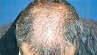 40代 男性 S.J.さん 前頭部・頭頂部の自毛植毛（MIRAI法） 2,000株の症例（施術前）