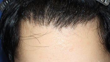 代 男性 S M さん 生え際の自毛植毛 Mirai法 1 800株 自毛植毛の症例
