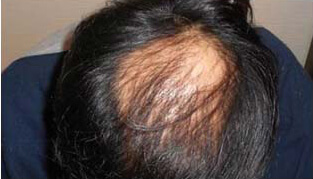 50代 男性 S.T.さん 生え際・頭頂部の自毛植毛（MIRAI法） 2,000株の症例（施術後）