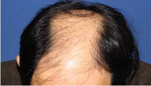 50代 男性 S.T.さん 生え際・頭頂部の自毛植毛（MIRAI法） 2,000株の症例（施術前）