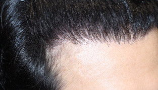 30代 男性 T.A.さん 生え際の自毛植毛（MIRAI法） 1,800株の症例（施術後）