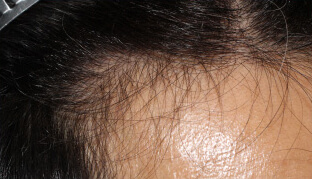 30代 男性 T.A.さん 生え際の自毛植毛（MIRAI法） 1,800株の症例（施術前）