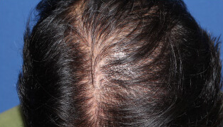 50代 男性 T.H.さん 頭頂部の自毛植毛（MIRAI法） 1,500株の症例（施術後）