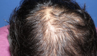 50代 男性 T.H.さん 頭頂部の自毛植毛（MIRAI法） 1,500株の症例（施術前）