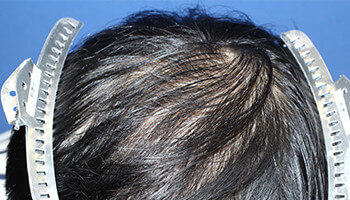 30代 男性 T.N.さん 頭頂部の自毛植毛（MIRAI法） 1,800株｜自毛植毛の症例（施術後）