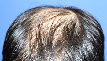 30代 男性 T.N.さん 頭頂部の自毛植毛（MIRAI法） 1,800株｜自毛植毛の症例（施術前）