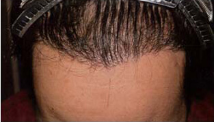 30代 男性 T.S.さん 前頭部の自毛植毛（MIRAI法） 1,000株の症例（施術後）