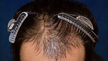 30代 男性 T.S.さん 前頭部の自毛植毛（MIRAI法） 1,000株の症例（施術前）