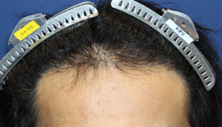 30代 男性 Y.T.さん 生え際の自毛植毛（MIRAI法） 2,300株の症例（施術後）