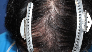 40代 男性 K.M.さん 生え際の自毛植毛（MIRAI法） 500株の症例（施術後）