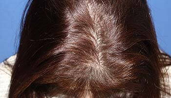 40代 女性 U.Y.さん 前頭部・頭頂部の自毛植毛（NC-MIRAI法） 600株の症例（施術後）