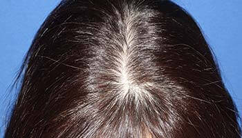 40代 女性 U.Y.さん 前頭部・頭頂部の自毛植毛（NC-MIRAI法） 600株の症例（施術前）
