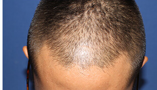 30代 男性 Y.T.さん 前頭部の自毛植毛（MIRAI法） 1,600株の症例（施術前）