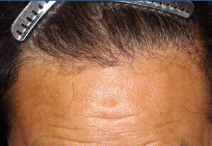 60代 男性 F.S.さん 生え際の自毛植毛（MIRAI法） 1,600株｜自毛植毛の症例（5ヶ月後）
