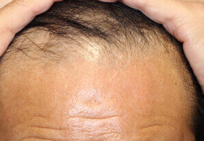 60代 男性 F.S.さん 生え際の自毛植毛（MIRAI法） 1,600株｜自毛植毛の症例（施術前）