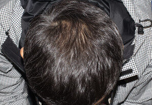 30代 男性 H.Y.さん 頭頂部の自毛植毛（MIRAI法） 2,700株の症例（5ヶ月後）
