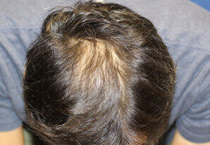 30代 男性 H.Y.さん 頭頂部の自毛植毛（MIRAI法） 2,700株の症例（施術前）