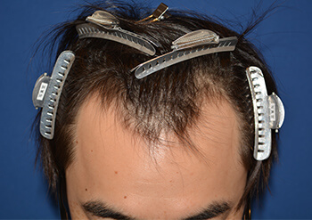 20代 男性 H.N.さん 生え際 自毛植毛（MIRAI法） 1,500株の症例（施術前）