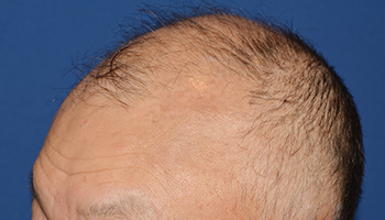 50代 男性 M.Y.さん  生え際 前頭部 自毛植毛（MIRAI法） 1,800株｜自毛植毛の症例（施術前）