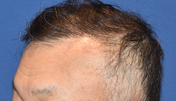 50代 男性 M.Y.さん  生え際 前頭部 自毛植毛（MIRAI法） 1,800株｜自毛植毛の症例（施術後）