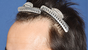 30代 男性 O.Y.さん  生え際 自毛植毛（NC-MIRAI法） 1,155株の症例（施術前）
