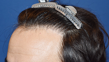 30代 男性 O.Y.さん  生え際 自毛植毛（NC-MIRAI法） 1,155株の症例（施術後）