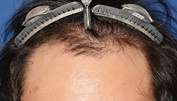 30代 男性 O.K.さん  生え際・前頭部・頭頂部 自毛植毛（MIRAI法） 2,650株の症例（施術前）