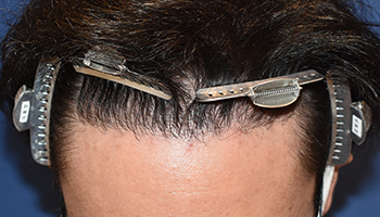 30代 男性 O.K.さん  生え際・前頭部・頭頂部 自毛植毛（MIRAI法） 2,650株の症例（施術後）